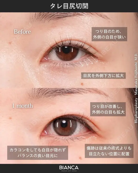 タレ目尻切開 after画像 メイン用