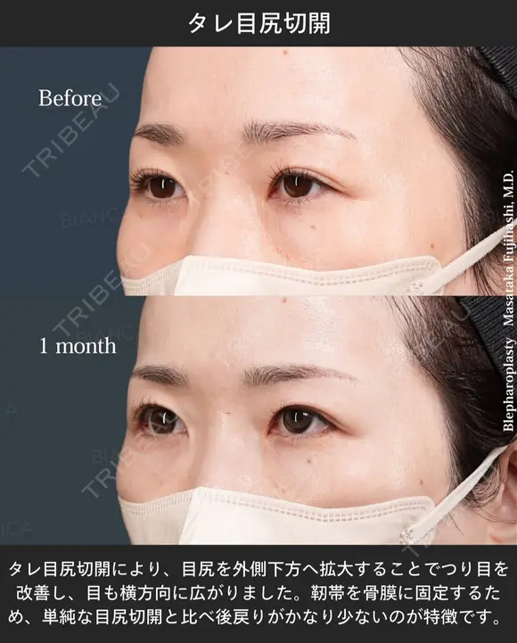 タレ目尻切開 after画像 メイン用