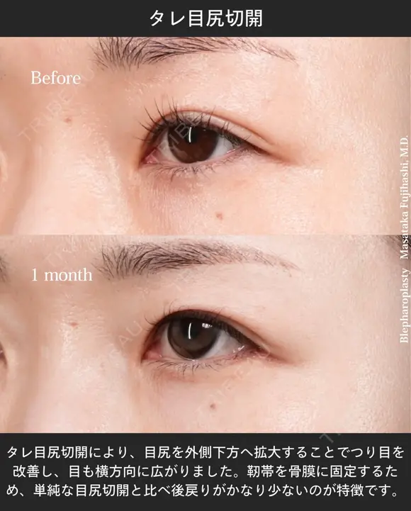 タレ目尻切開 after画像 メイン用