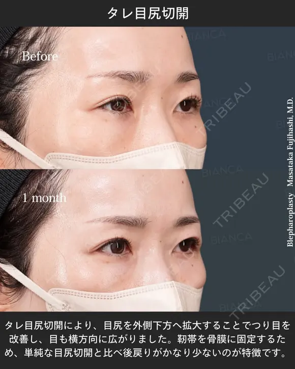 タレ目尻切開 after画像 メイン用