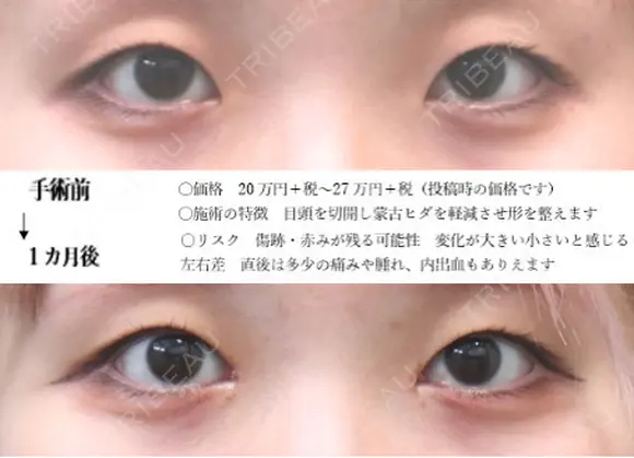 目頭切開法 before画像 メイン用