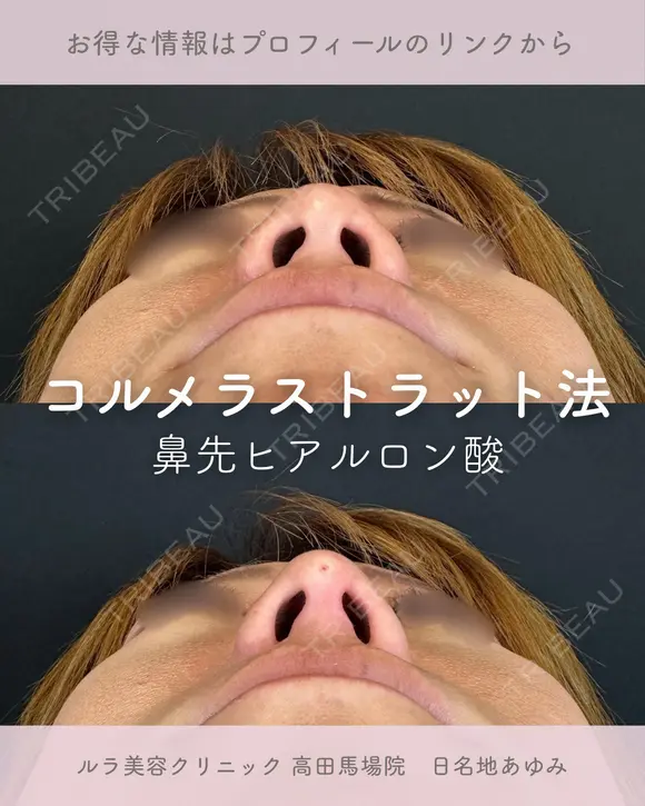 鼻先ヒアルロン酸（コルメラストラット法） after画像 メイン用