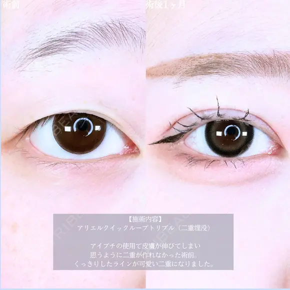 アリエルクイックループトリプル二重埋没法 before画像 メイン用