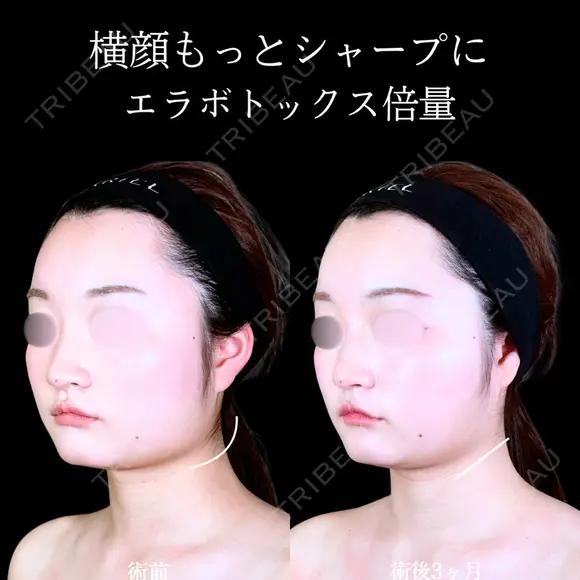エラボトックス before画像 メイン用