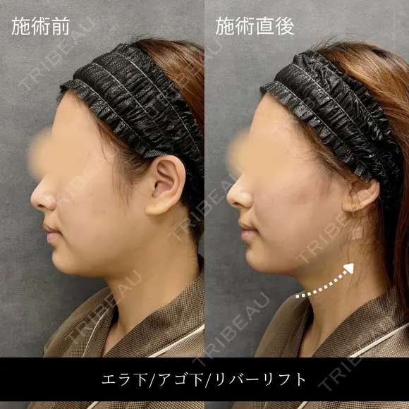 リバー式小顔脂肪吸引 before画像 メイン用