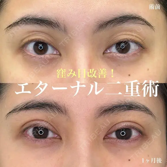 二重埋没（エターナル二重術） after画像 メイン用
