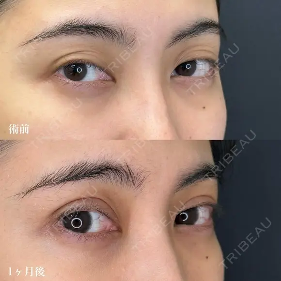 二重埋没（エターナル二重術） after画像 メイン用