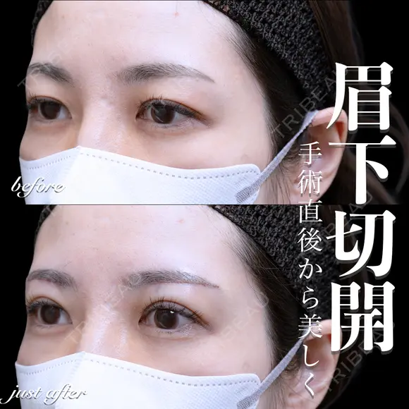 眉下切開 0日後 メイン用