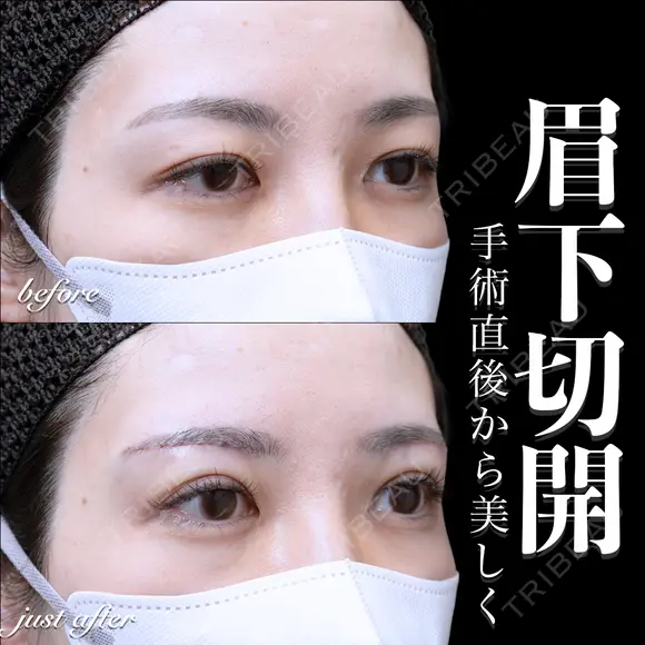 眉下切開 0日後 メイン用