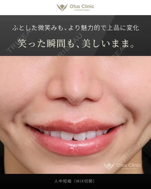 人中短縮（MIX切開） 180日後 メイン用