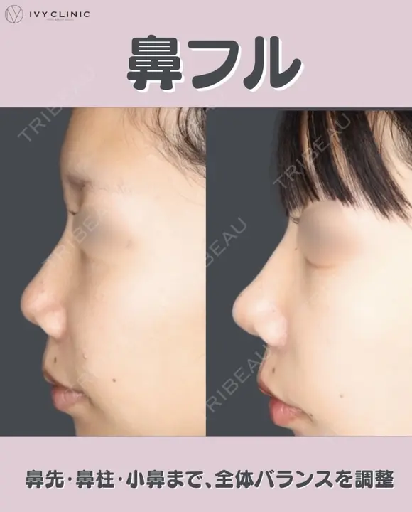 鼻尖形成　軟骨移植　鼻柱下降　小鼻縮小 before画像 メイン用
