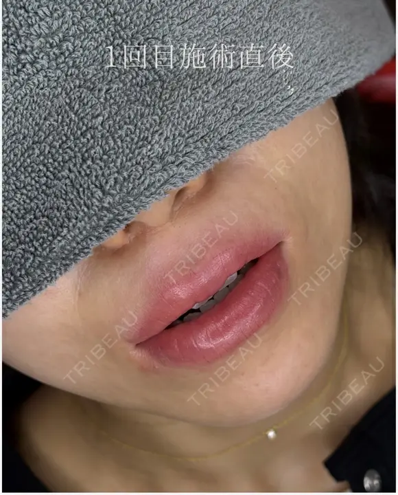 リップアートメイク初回（アトピー既往あり） after画像 メイン用