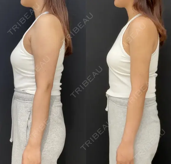 シークレット脂肪吸引二の腕 after画像 メイン用