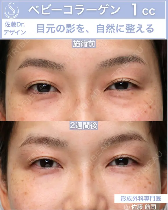 【30代女性】ベビーコラーゲン 14日後 メイン用