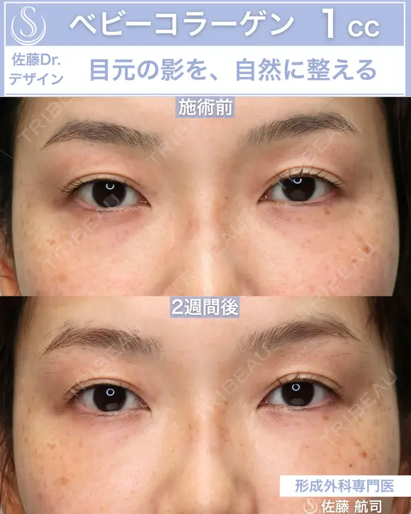 【30代女性】ベビーコラーゲン 14日後 メイン用
