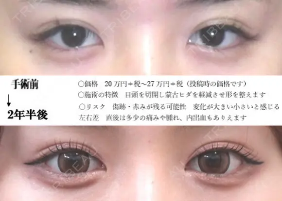 目頭切開法 before画像 メイン用
