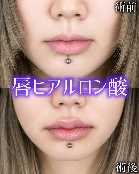 Cカールリップ 0日後 メイン用