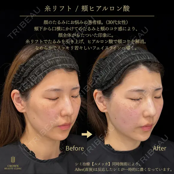 糸リフト・頬ヒアルロン酸 before画像 メイン用