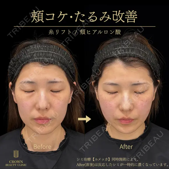 糸リフト・頬ヒアルロン酸 0日後 メイン用