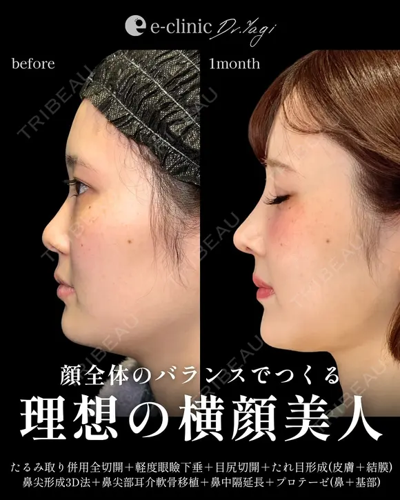 鼻整形×目元整形 after画像 メイン用