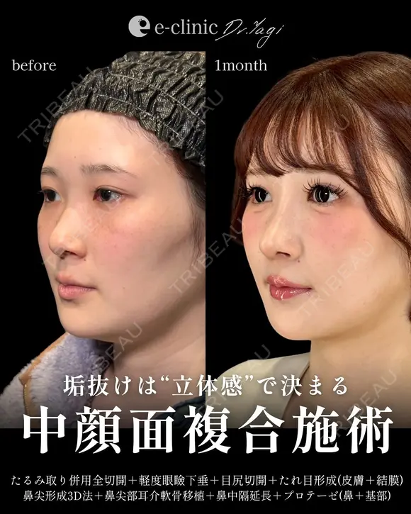 鼻整形×目元整形 before画像 メイン用