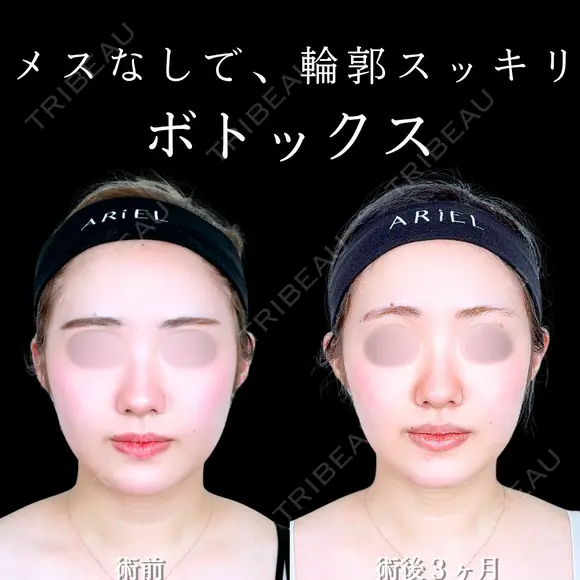 エラボトックス 90日後 メイン用