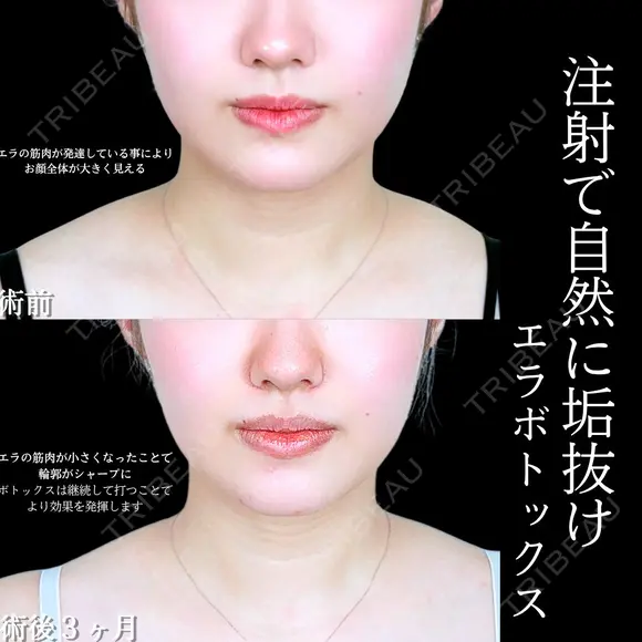 エラボトックス before画像 メイン用
