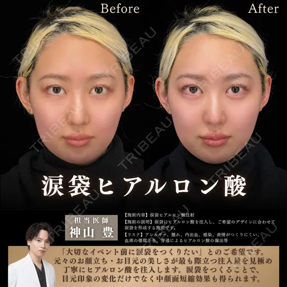涙袋ヒアルロン酸 before画像 メイン用