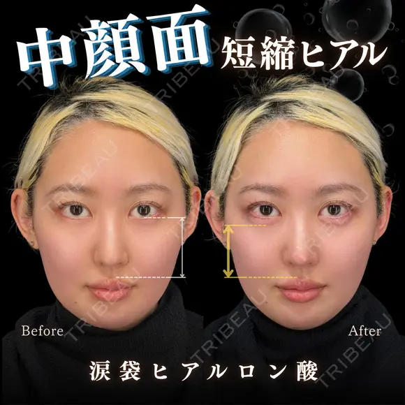 涙袋ヒアルロン酸 0日後 メイン用