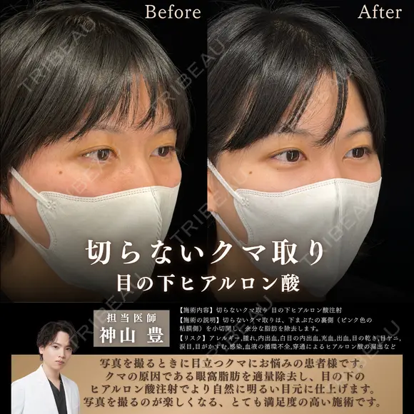 切らないクマ取り before画像 メイン用