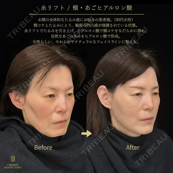 糸リフト・頬ヒアルロン酸・あごヒアルロン酸 before画像 メイン用