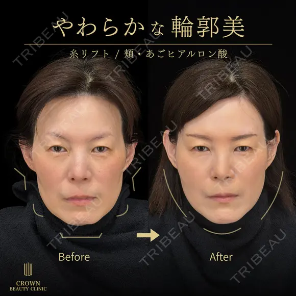 糸リフト・頬ヒアルロン酸・あごヒアルロン酸 31日後 メイン用
