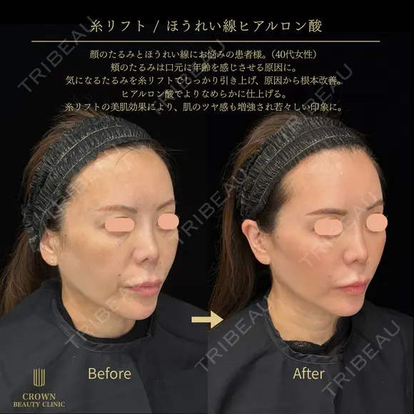 糸リフト・ほうれい線ヒアルロン酸 before画像 メイン用