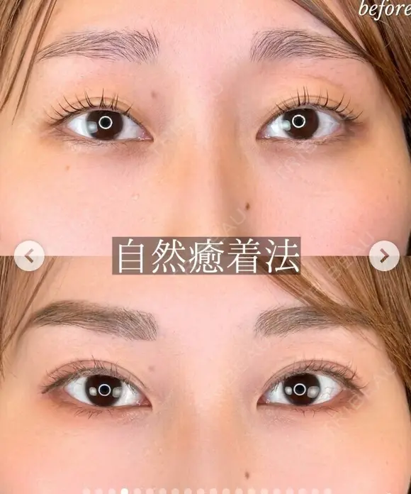 エターナル二重術 before画像 メイン用