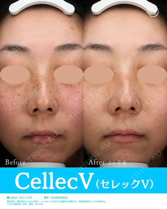 セレックV before画像 メイン用