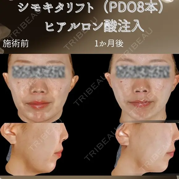 糸リフト、ヒアルロン酸注入 before画像 メイン用