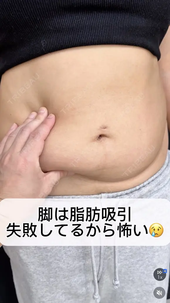 シークレット脂肪吸引お腹 before画像 メイン用
