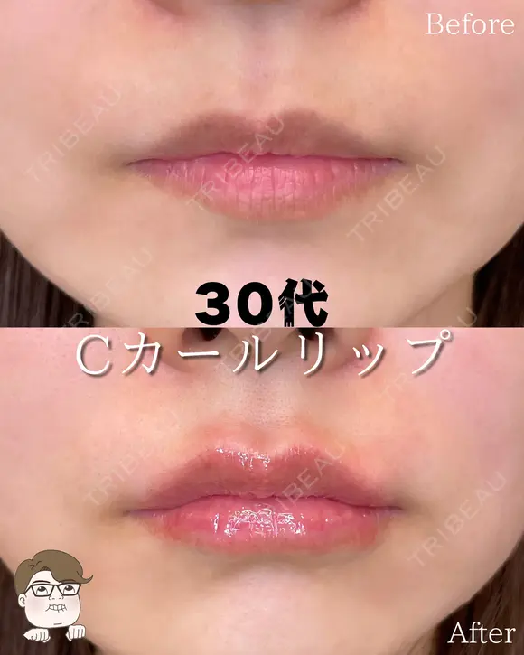 Cカールリップ before画像 メイン用