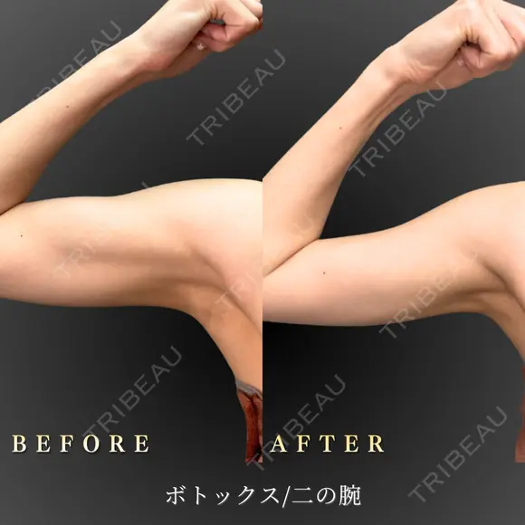 二の腕ボトックス before画像 メイン用