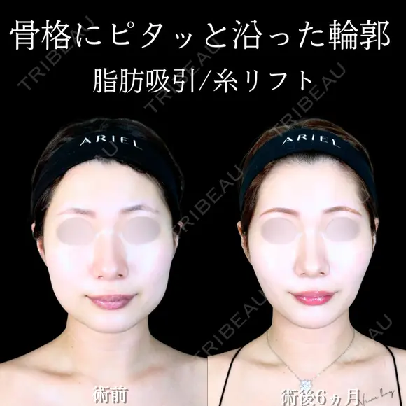 頬・顎下脂肪吸引/バッカルファット/ジョールファット/糸リフト/エラボトックス/顎ヒアルロン酸 180日後 メイン用