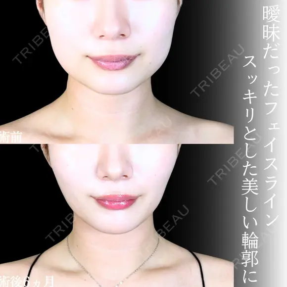 頬・顎下脂肪吸引/バッカルファット/ジョールファット/糸リフト/エラボトックス/顎ヒアルロン酸 before画像 メイン用