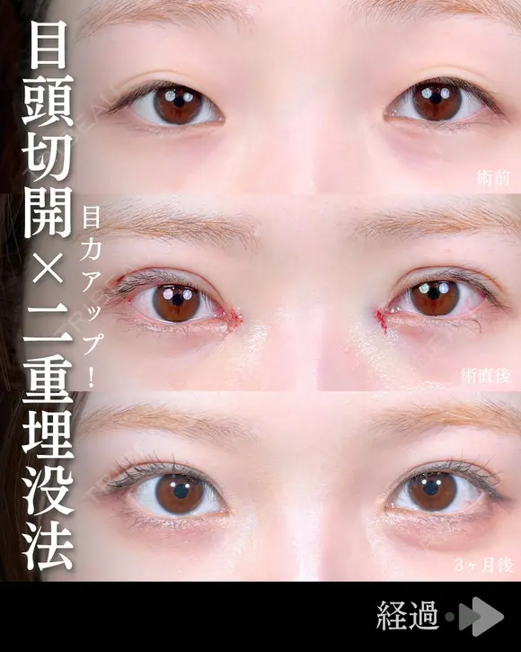 MD式目頭切開/二重埋没法 90日後 メイン用