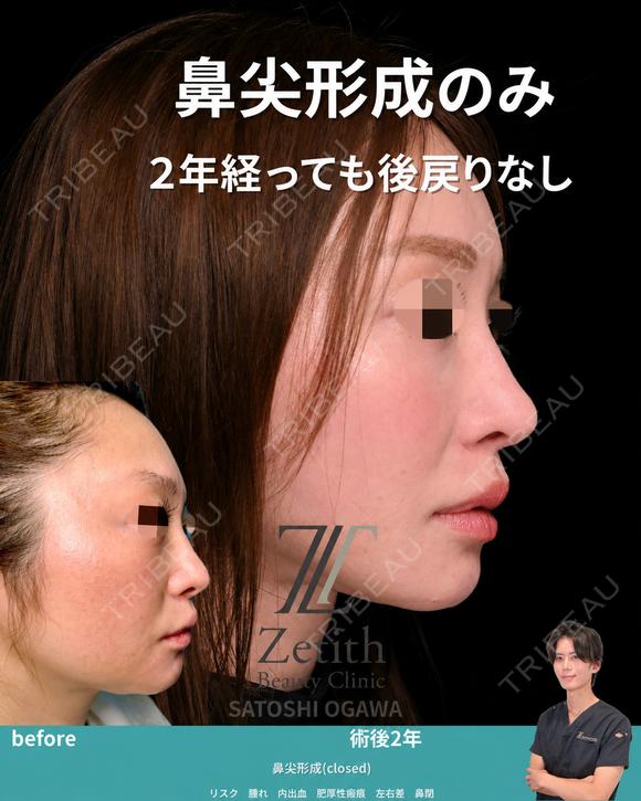 クローズド法による鼻尖形成 730日後 メイン用