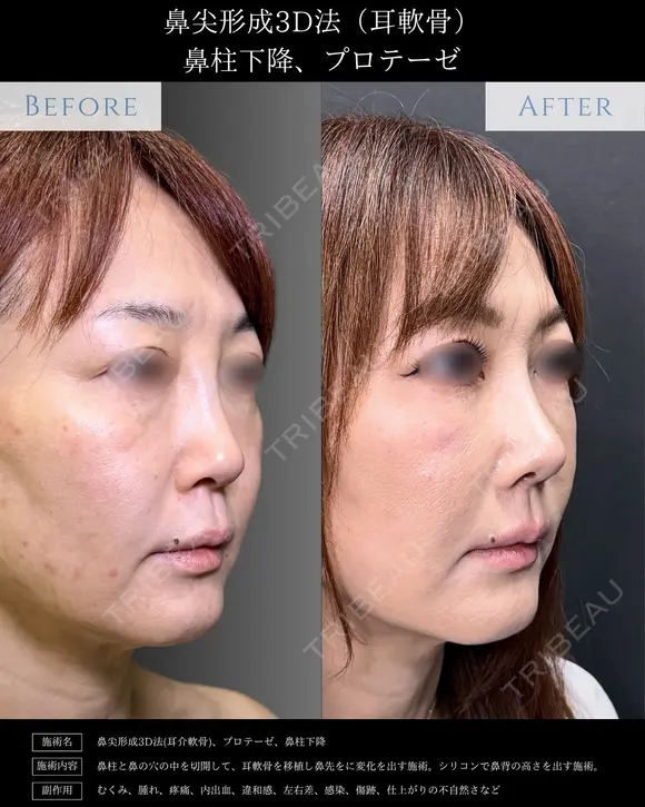 【鼻フル整形】鼻尖形成3D法＋耳介軟骨移植＋鼻柱下降＋プロテーゼ before画像 メイン用