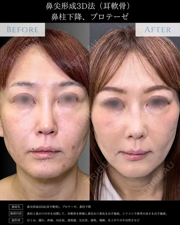 【鼻フル整形】鼻尖形成3D法＋耳介軟骨移植＋鼻柱下降＋プロテーゼ after画像 メイン用