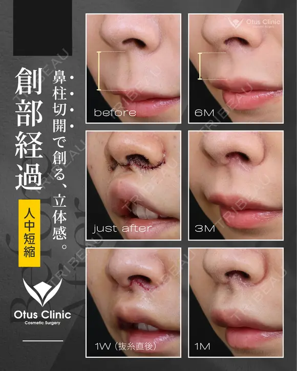 人中短縮（鼻柱切開）/ 貴族組織移植 before画像 メイン用