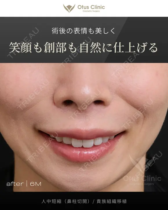 人中短縮（鼻柱切開）/ 貴族組織移植 before画像 メイン用
