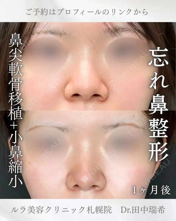 鼻尖形成耳介軟骨移植（クローズ法）、小鼻縮小 before画像 メイン用