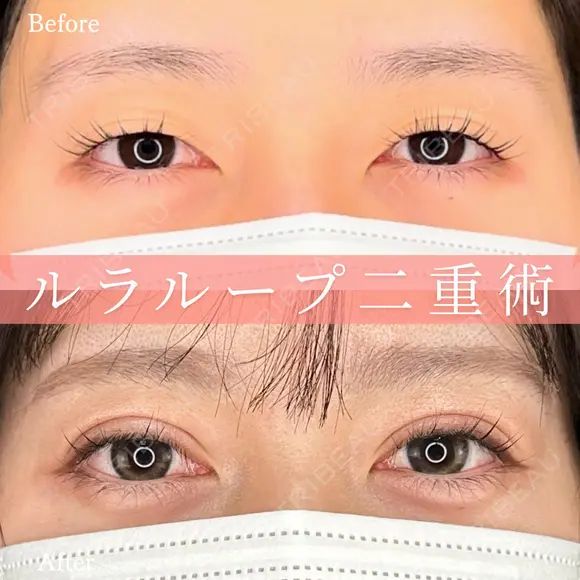 1Dayルラループ二重術 before画像 メイン用