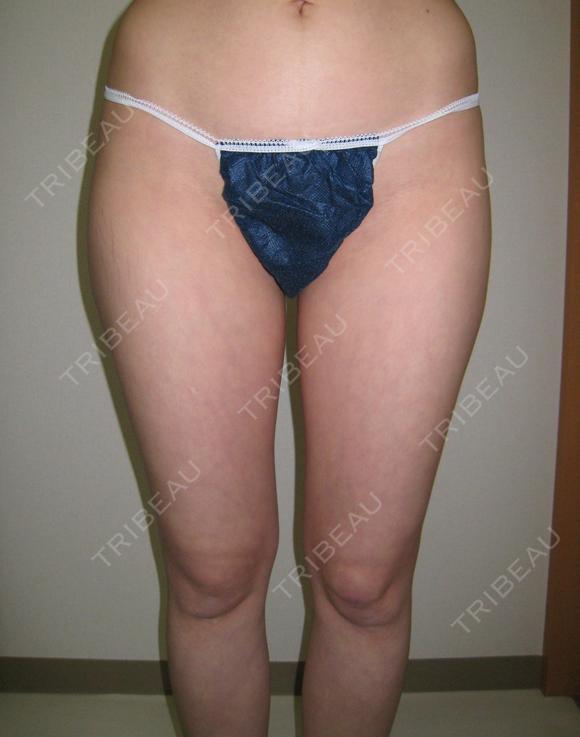 美しいしあがり専門医総院長によるこだわりの脂肪吸引　部位脚 before画像 メイン用
